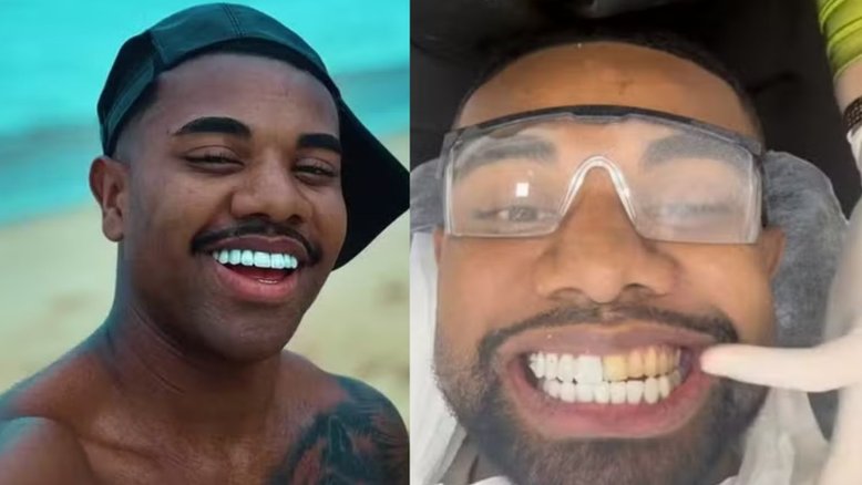 Davi Brito troca as lentes de contato nos dentes