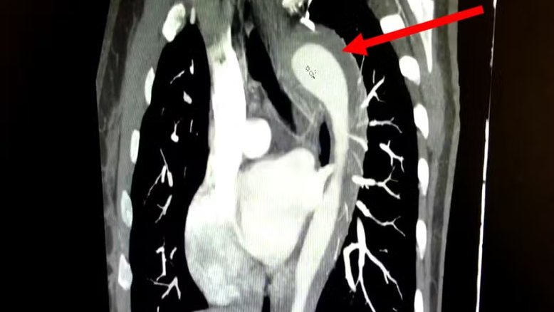aorta