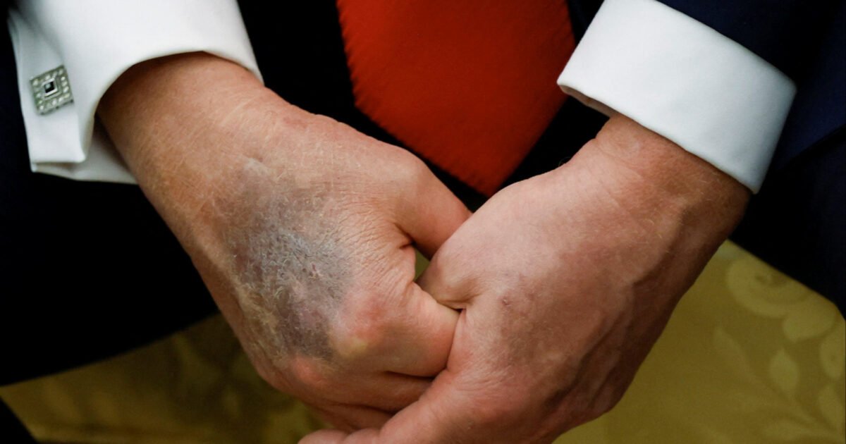 Trump volta a apresentar hematoma na mão; Casa Branca fala em irritação de pele