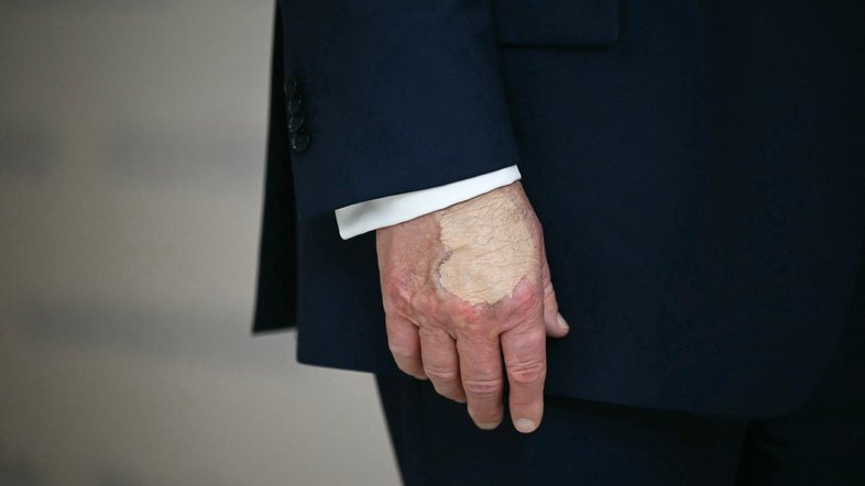 Rumores sobre Trump ganharam força após última aparição pública do republicano com hematoma na mão, fruto da condição de IVC