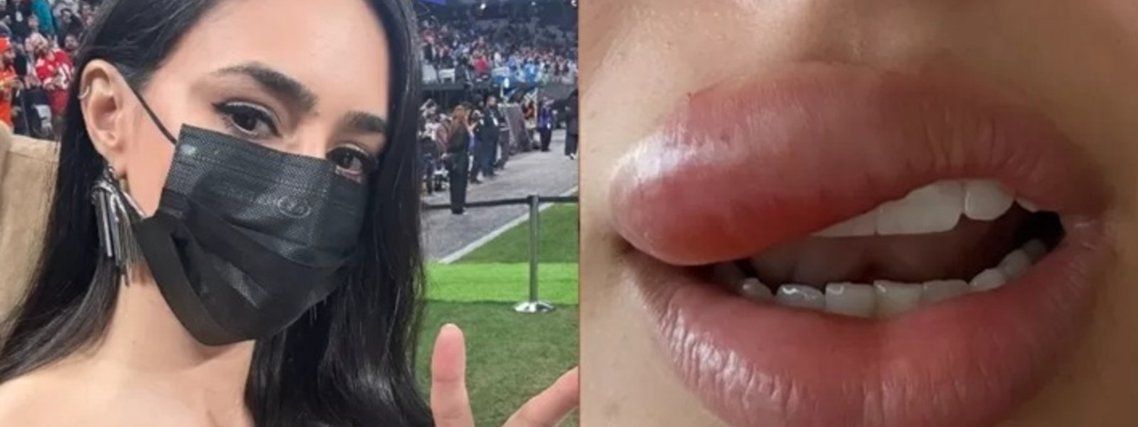 Bruna Biancardi aparece com a boca inchada