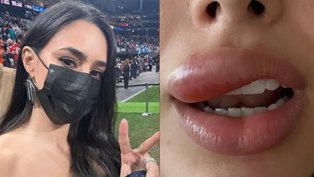 Bruna Biancardi aparece com a boca inchada