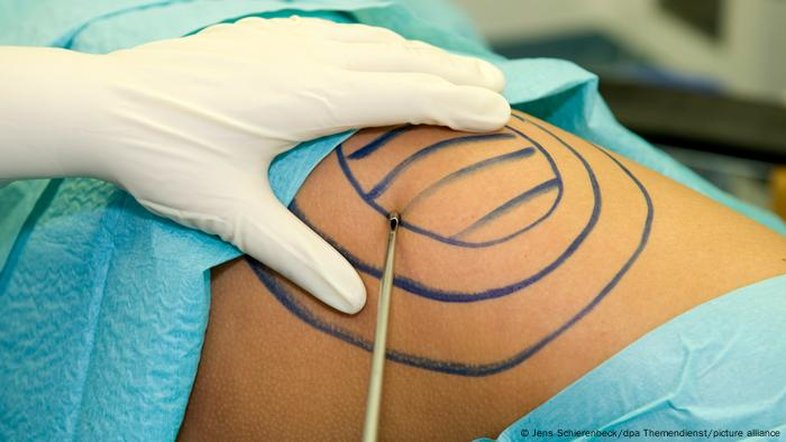 Lipoaspiração: a cirurgia plástica mais realizada no Brasil