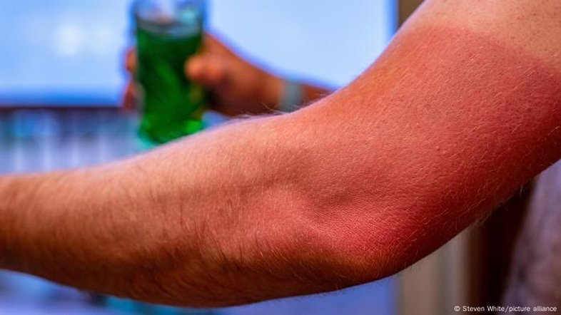 Entenda o escândalo dos protetores solares na Austrália
