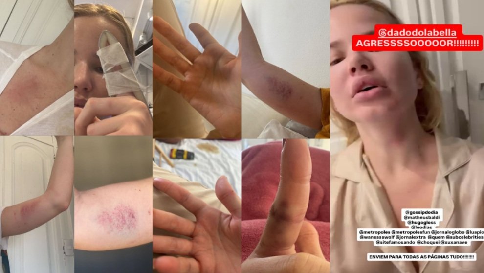 Dado Dolabella é acusado de agredir namorada, Marcela Tomaszewski 2 Agressões à Marcela, postadas por Rafaela sua amiga