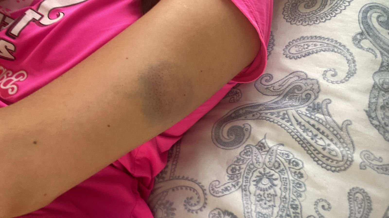 Hematoma no braço de Laís Gamarra