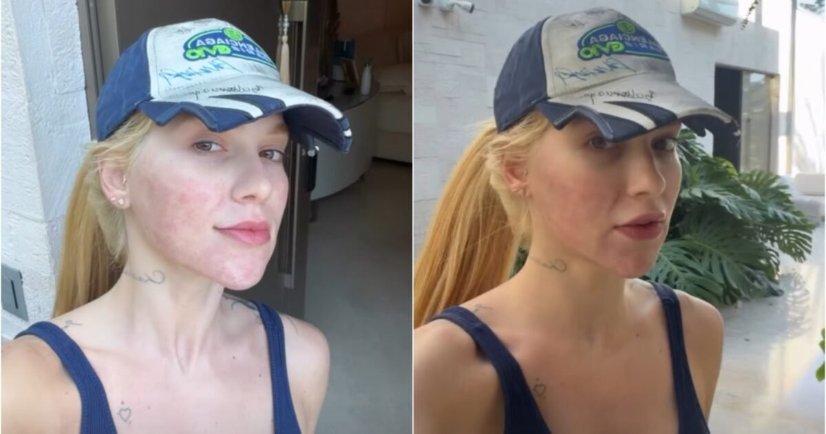 Virginia Fonseca exibe rosto marcado após tratamento com laser para acne