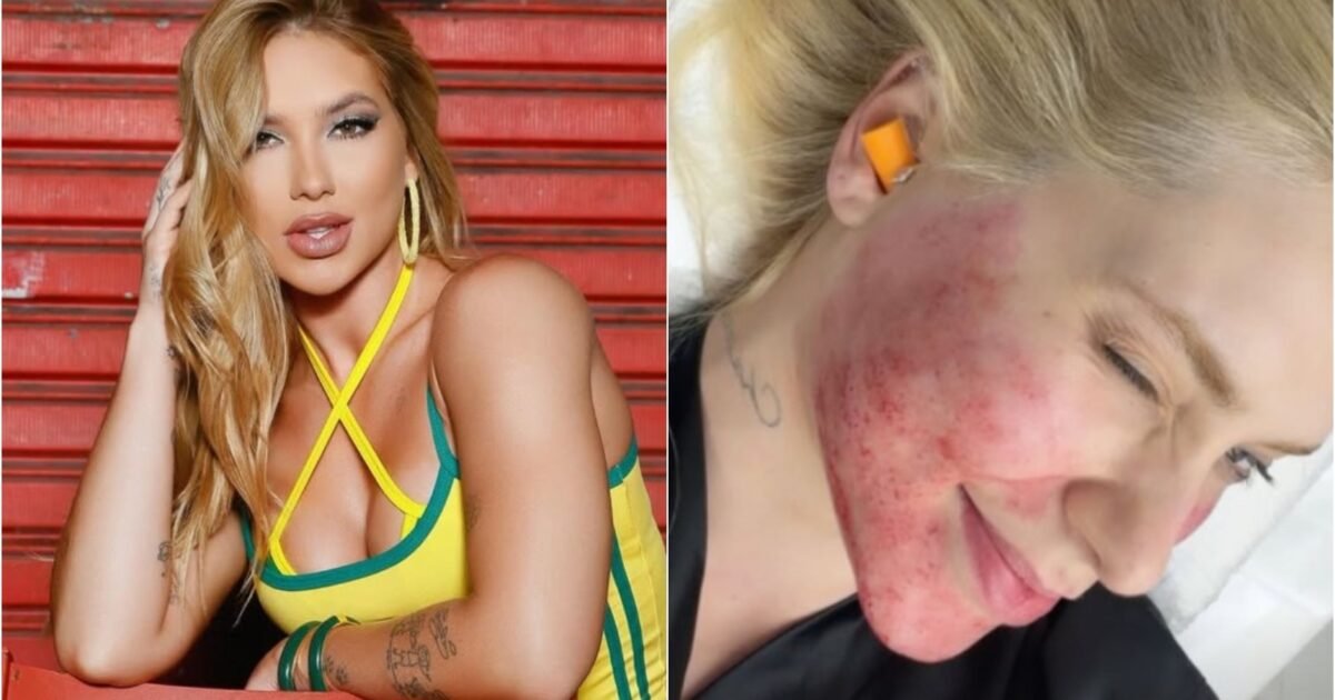 Procedimento de Virginia Fonseca chama atenção para tratamentos agressivos