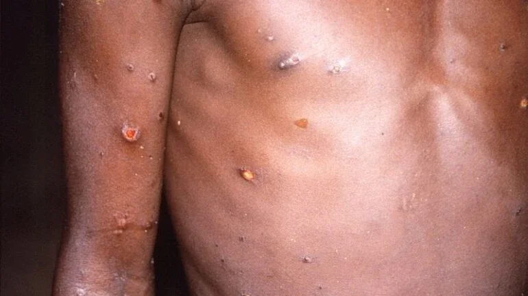 CDC/Brian W.J. Mahy/Divulgação via REUTERS