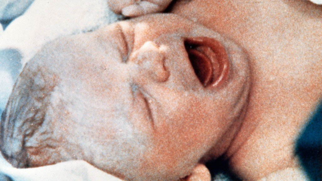 Nasce o primeiro bebê de proveta Nasce o primeiro bebê de proveta