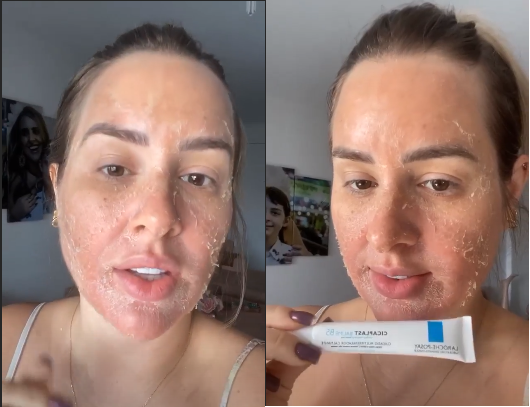 Ex-BBB Patrícia Leitte faz procedimento para remover melasma, veja Ex-BBB Patrícia Leitte faz procedimento para remover melasma, veja