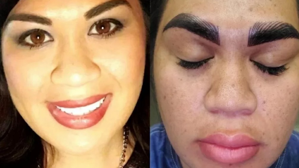 Woman says ‘terrifying’ after she paid R$1,700 for eyebrow surgery