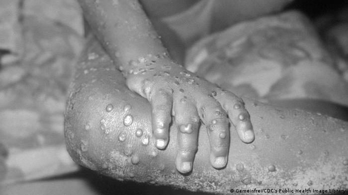 OMS confirma 92 casos de varíola de macaco em 12 países