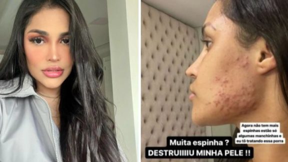 Médico explica por que ‘chip da beleza’ destruiu pele do rosto da ex-BBB Flay