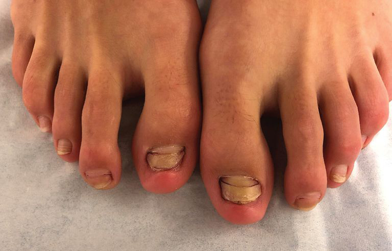 Oi? Mulher perde unhas dos pés após ir a pedicure de peixes