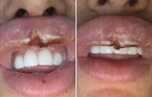 Mulher fica com boca deformada e quase perde lábio após botox