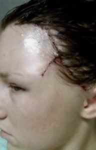 Vício em bronzeamento artificial faz mulher perder pedaço do rosto