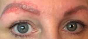 Mulher sofre infecção horrível após fazer sobrancelha com microblading