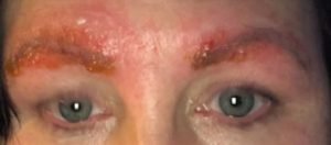 Mulher sofre infecção horrível após fazer sobrancelha com microblading