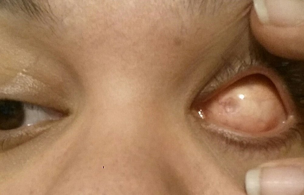 Atenção no Carnaval: glitter no rosto faz mulher perder um olho 3 Atenção no Carnaval: glitter no rosto faz mulher perder um olho