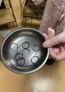 Mulher é operada após colocar mola de metal na vagina para não engravidar
